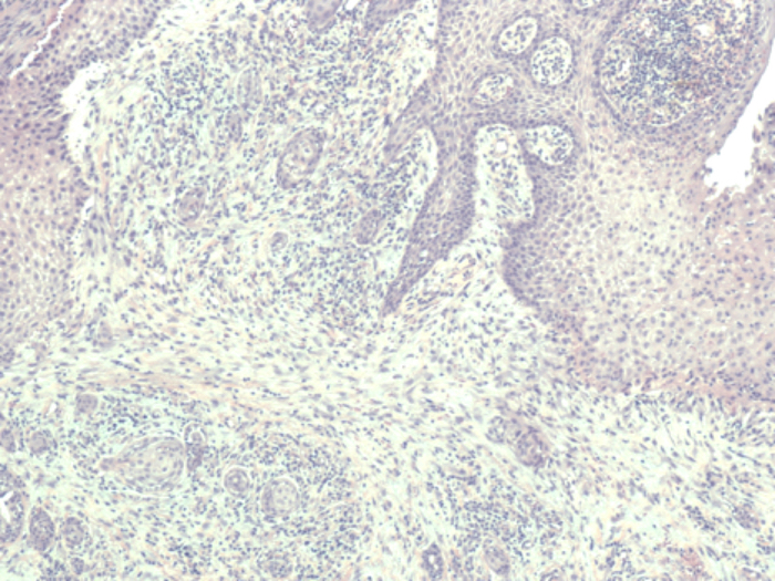 A Man With Non-Healing Ulcer In Mouth
